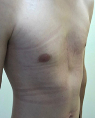 Three weeks after non-corrective surgery with pectus implant