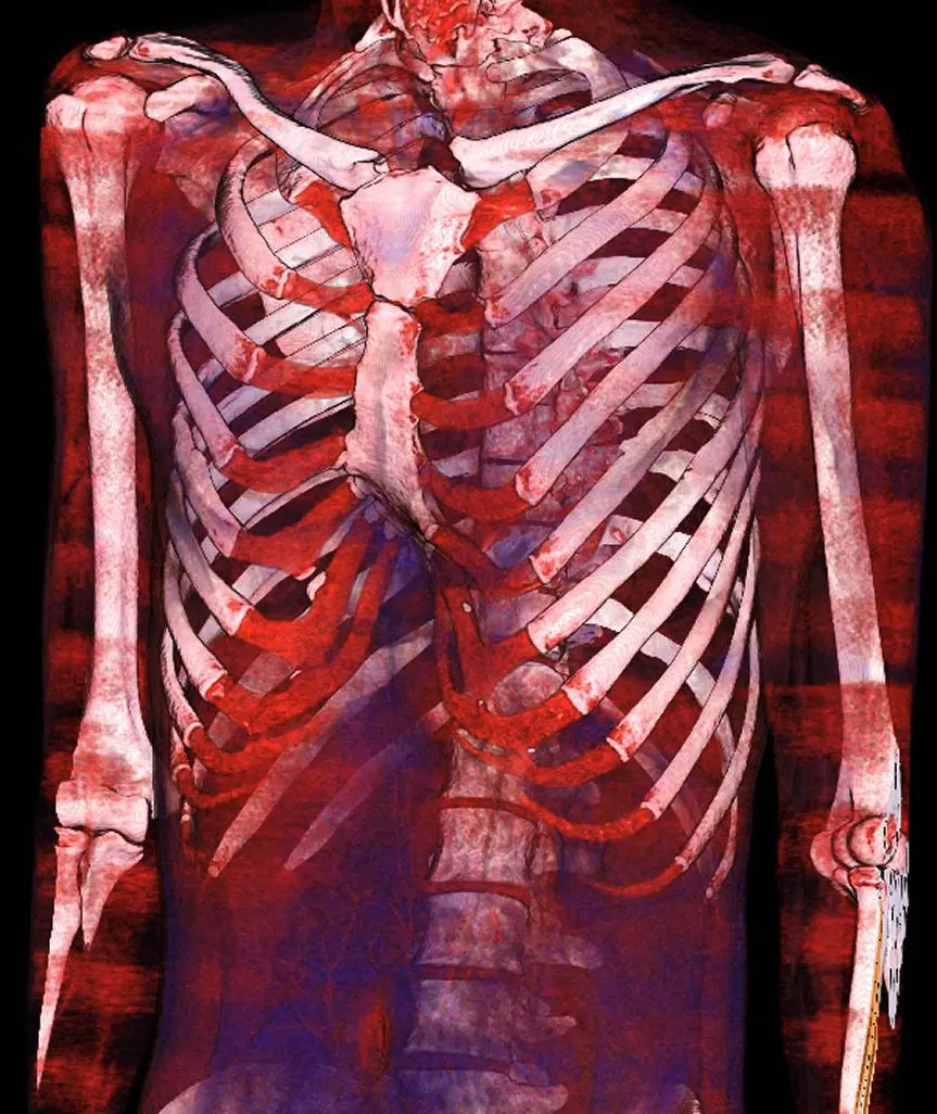 CT 3D reconstruction showing inward displacement of costal cartilage in pectus excavatum