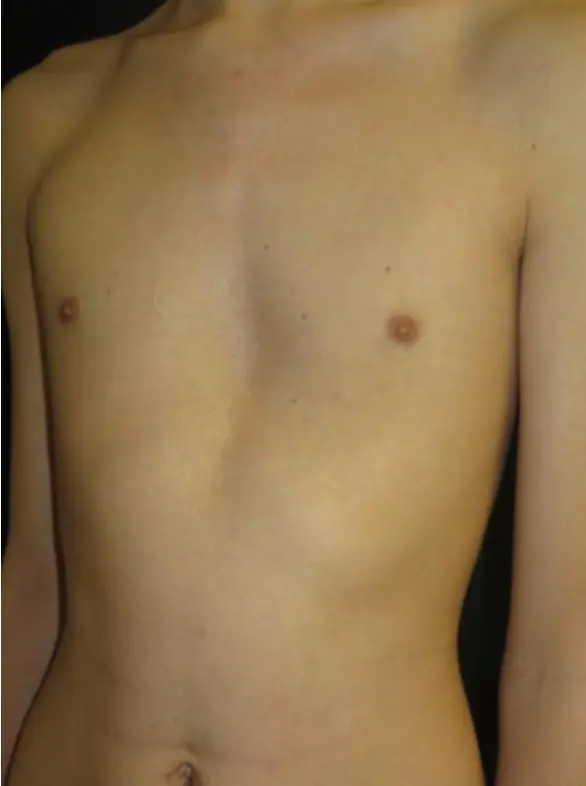 After — rib flare with VBT