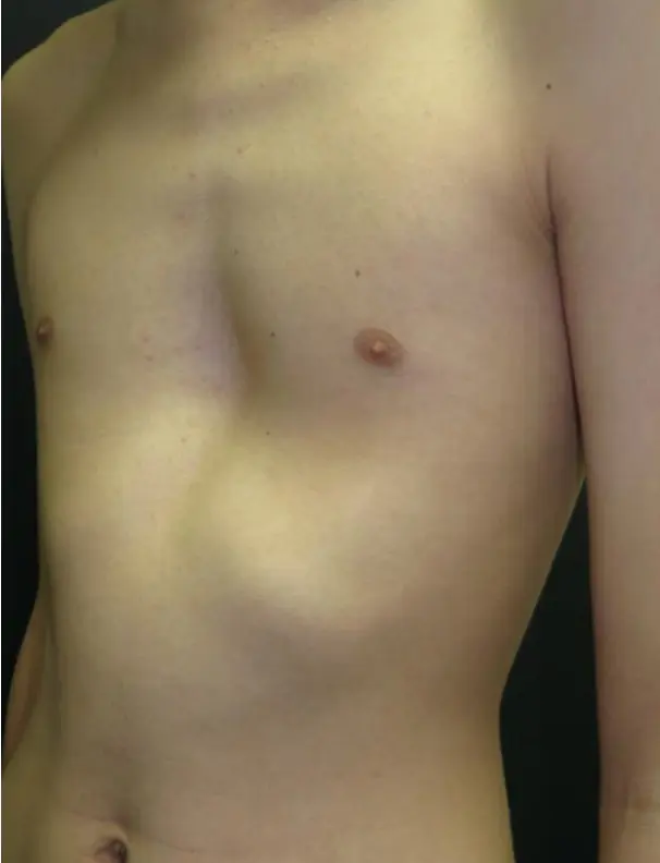 Before — rib flare with VBT