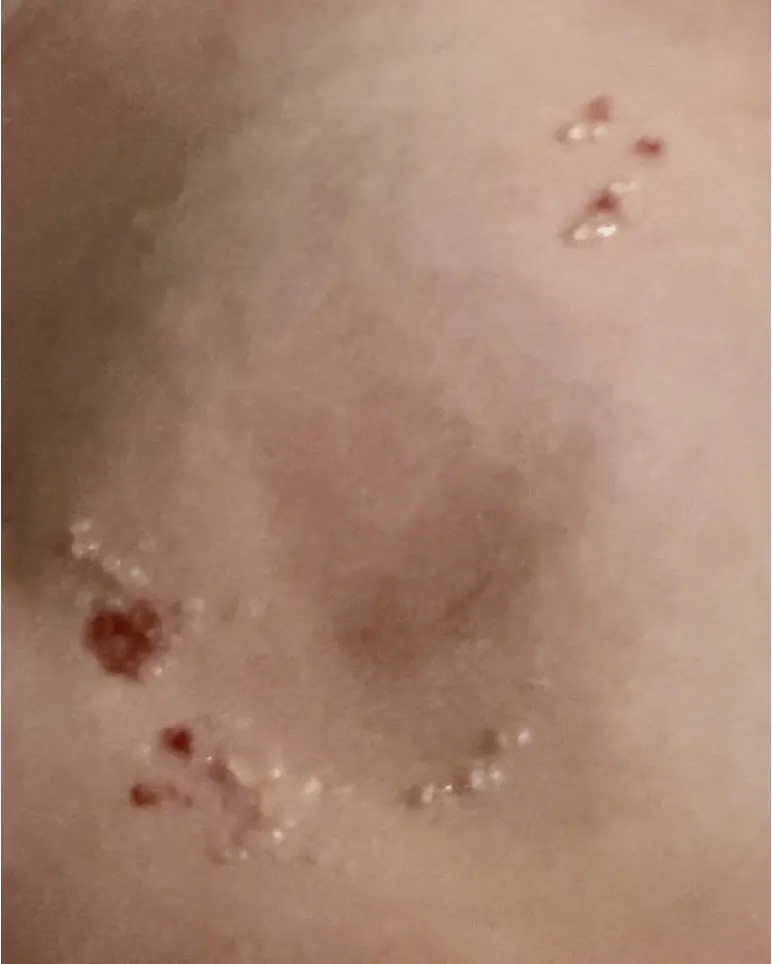Blistering from VBT