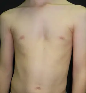 Initial skin change
