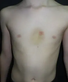During recovery