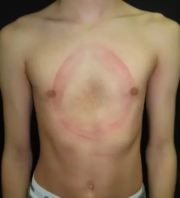 Moderate silicone contact reaction
