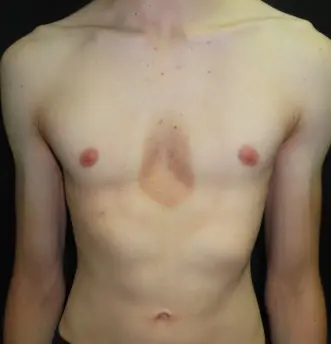 Severe skin reaction with discolouration