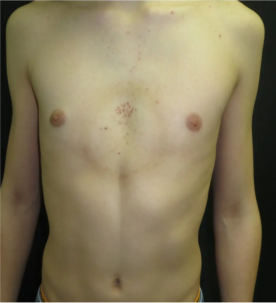 Minor petechiae from VBT suction