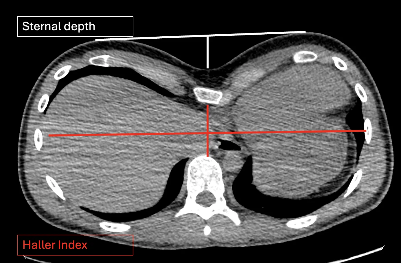 CT showing sternal depth and Haller Index