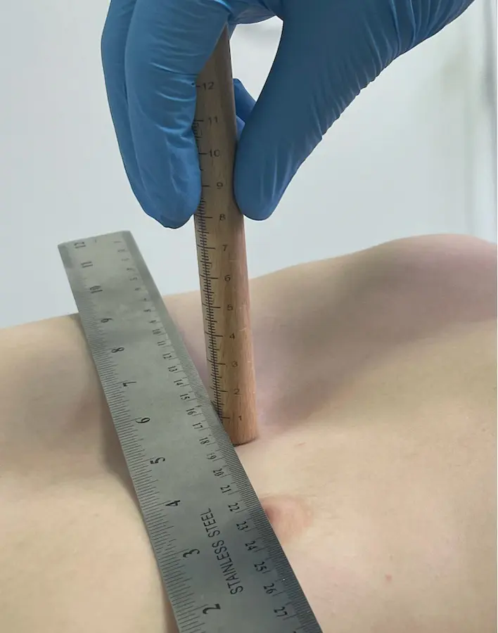 Sternal depth measurement in pectus excavatum