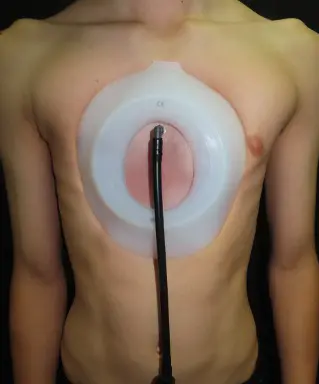 Vacuum bell applied to chest wall